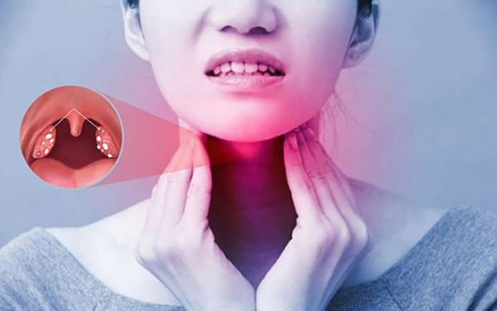 Vì sao dễ bị viêm họng vào mùa hè? Nguyên nhân và cách phòng ngừa hiệu quả