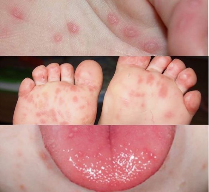 Cách phòng ngừa bệnh tay chân miệng hiệu quả cho trẻ em