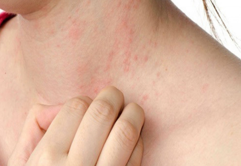 Nguyên nhân gây nổi rôm sảy ở người lớn và cách điều trị hiệu quả