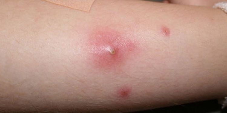 Mụn nhọt mùa hè: Nguyên nhân, dấu hiệu, biến chứng và cách điều trị hiệu quả
