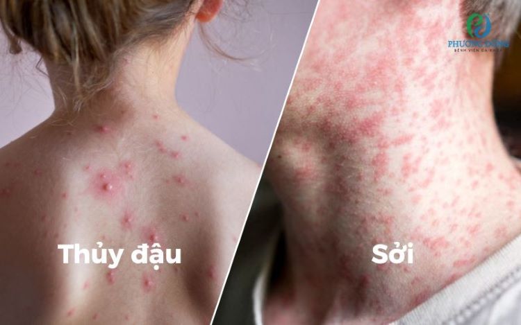 Sởi và thủy đậu – Hai bệnh truyền nhiễm mùa hè không nên chủ quan