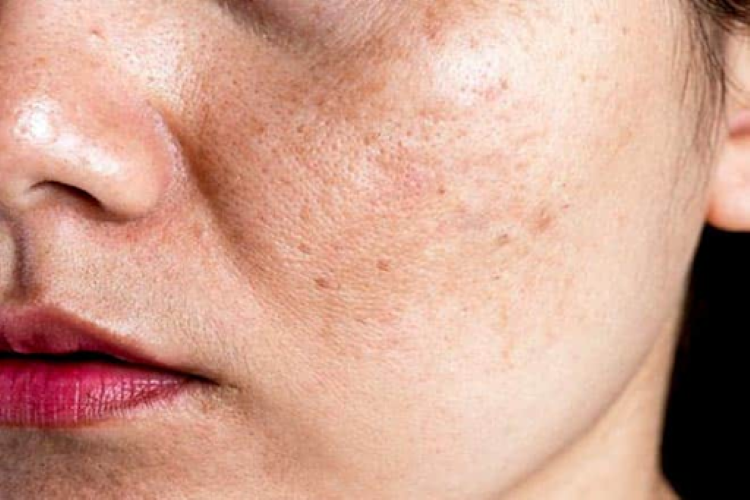 Ăn gì để trị nám và tàn nhang? Gợi ý thực phẩm giúp da sáng khỏe từ bên trong