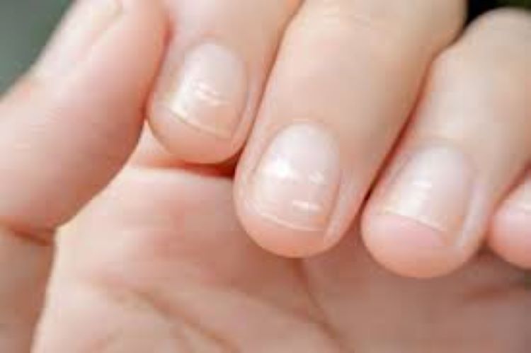 5 dấu hiệu trên móng tay cảnh báo bạn đang thiếu vitamin nghiêm trọng