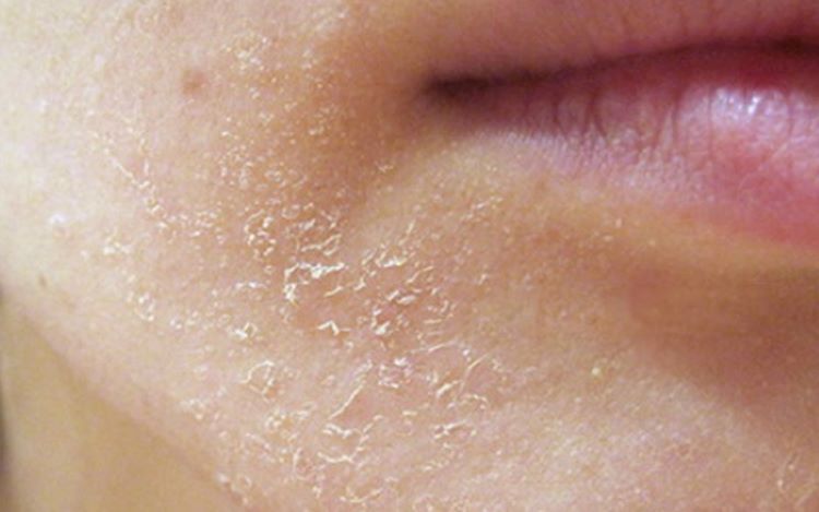 Vitamin giúp da giảm tình trạng khô ráp vào mùa lạnh