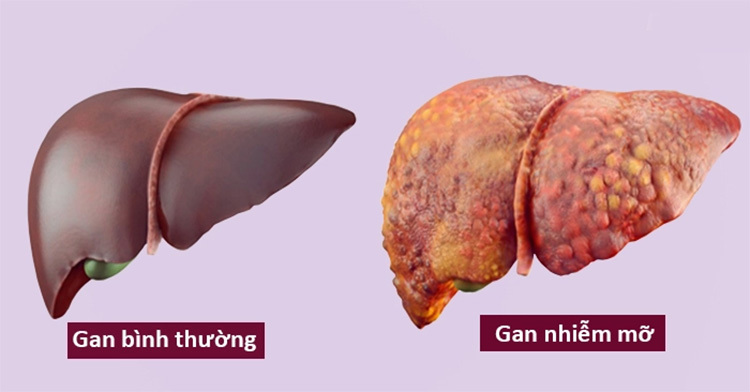 Gan Nhiễm Mỡ: 8 Dấu Hiệu Cảnh Báo Sớm Nhiều Người Đang Bỏ Qua