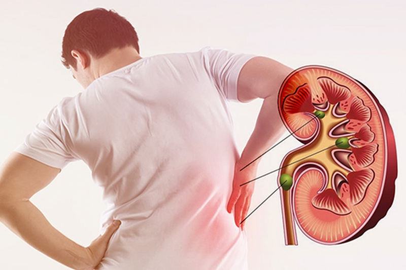 Sỏi Thận: 8 Dấu Hiệu Cảnh Báo Không Nên Chờ Đến Khi Đau Quặn Mới Đi Khám