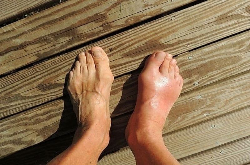 Gout: 7 Dấu Hiệu Cảnh Báo, Nguyên Nhân Và Những Sai Lầm Khiến Bệnh Nặng Hơn