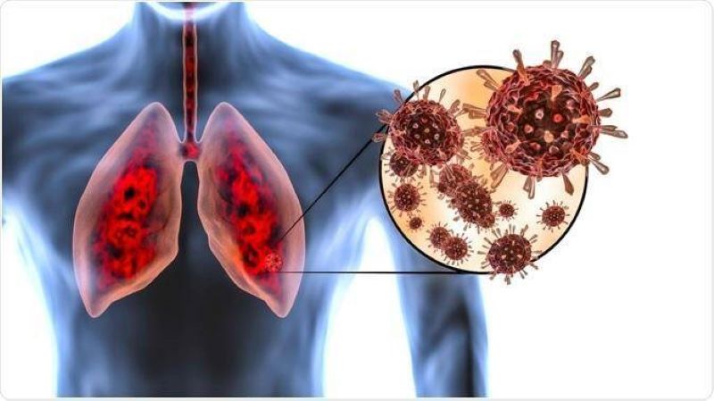 Viêm Phổi: 9 Dấu Hiệu Cảnh Báo Dễ Nhầm Với Cảm Cúm, Phát Hiện Sớm Để Tránh Biến Chứng