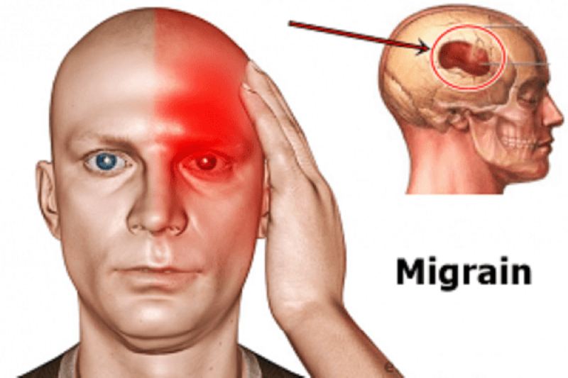 Đau Nửa Đầu Migraine: 9 Dấu Hiệu Cảnh Báo Và Khi Nào Cần Đi Khám