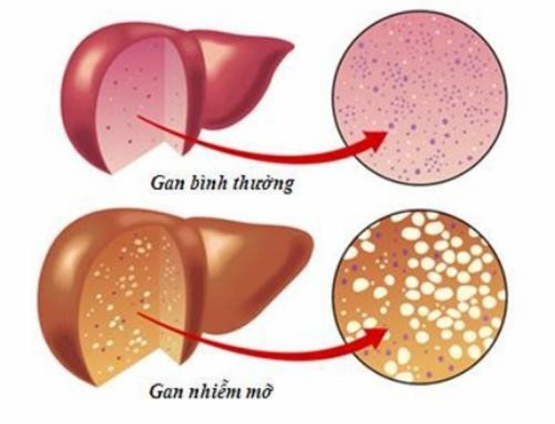 Gan nhiễm mỡ không do rượu: Dấu hiệu, nguyên nhân và khi nào cần đi khám?