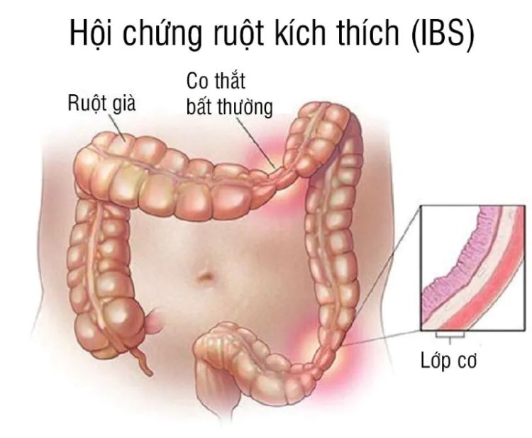 Hội chứng ruột kích thích (IBS): Triệu chứng, nguyên nhân, cách kiểm soát và khi nào cần đi khám?