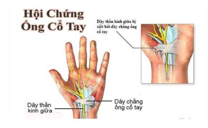 Tê tay về đêm, hay làm rơi đồ: Có thể là hội chứng ống cổ tay