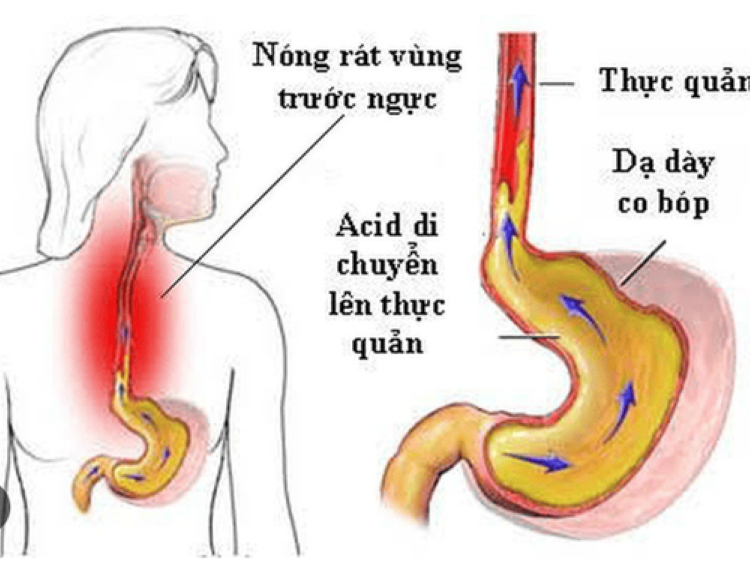 Trào ngược thanh quản – hầu: Ho kéo dài, vướng họng có thể không phải do viêm họng