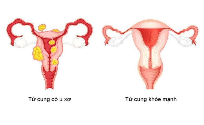 U xơ tử cung: Kinh nguyệt ra nhiều, đau bụng có phải dấu hiệu bất thường?