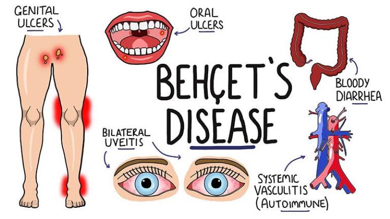 Bệnh Behçet: Căn bệnh hiếm với những dấu hiệu tưởng như rất bình thường