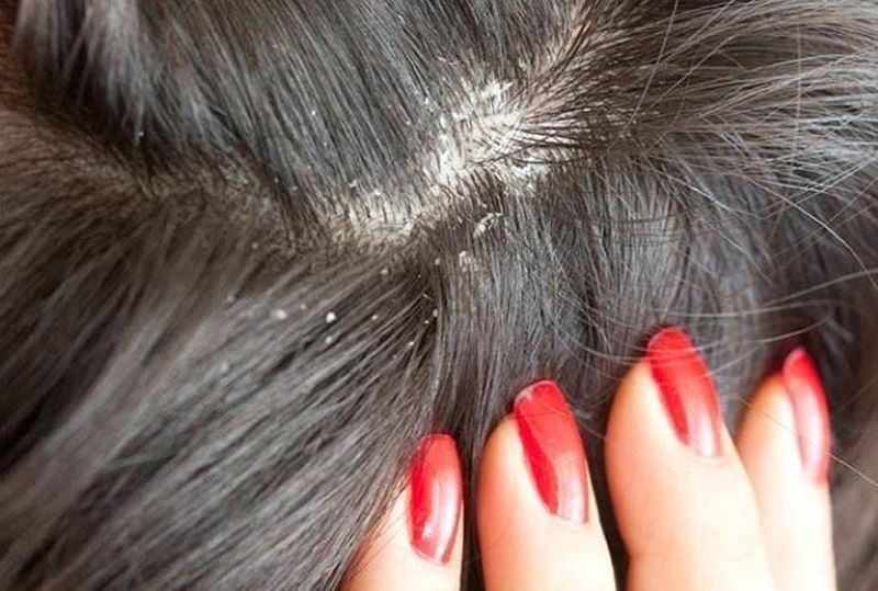 10+ Cách Trị Gàu Da Đầu Hiệu Quả, Giảm Ngứa Và Bong Vảy
